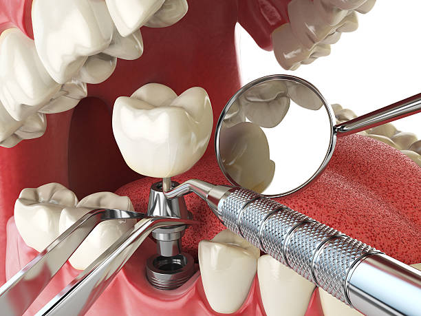 Best Emergency Dental Care for Broken or Chipped Teeth in La Mirada, CA